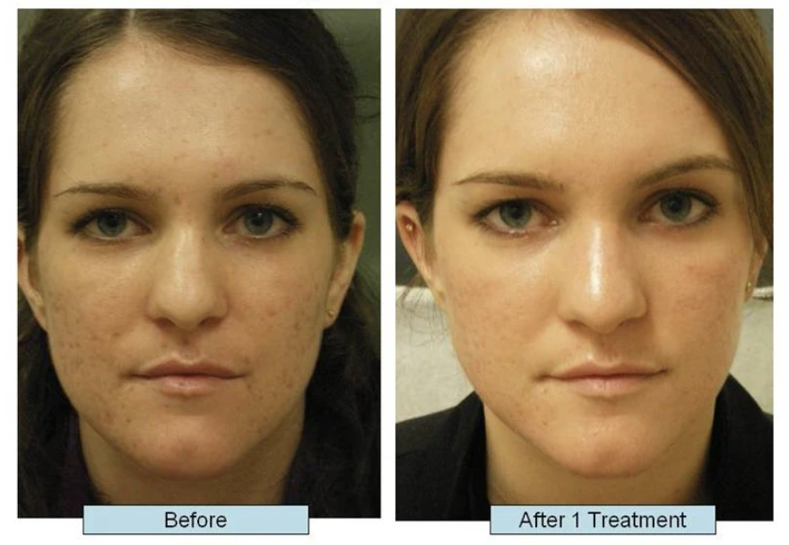 Acne Scar Treatments